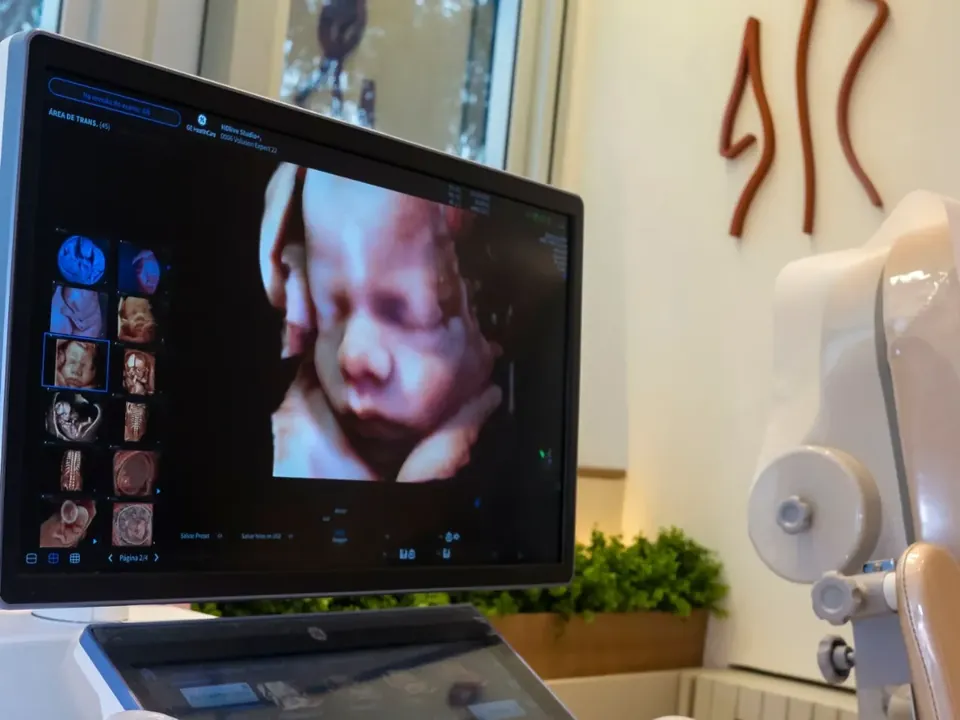 Monitor do aparelho de ultrassom com a imagem 3D do bebê, no consultório na Barra da Tijuca