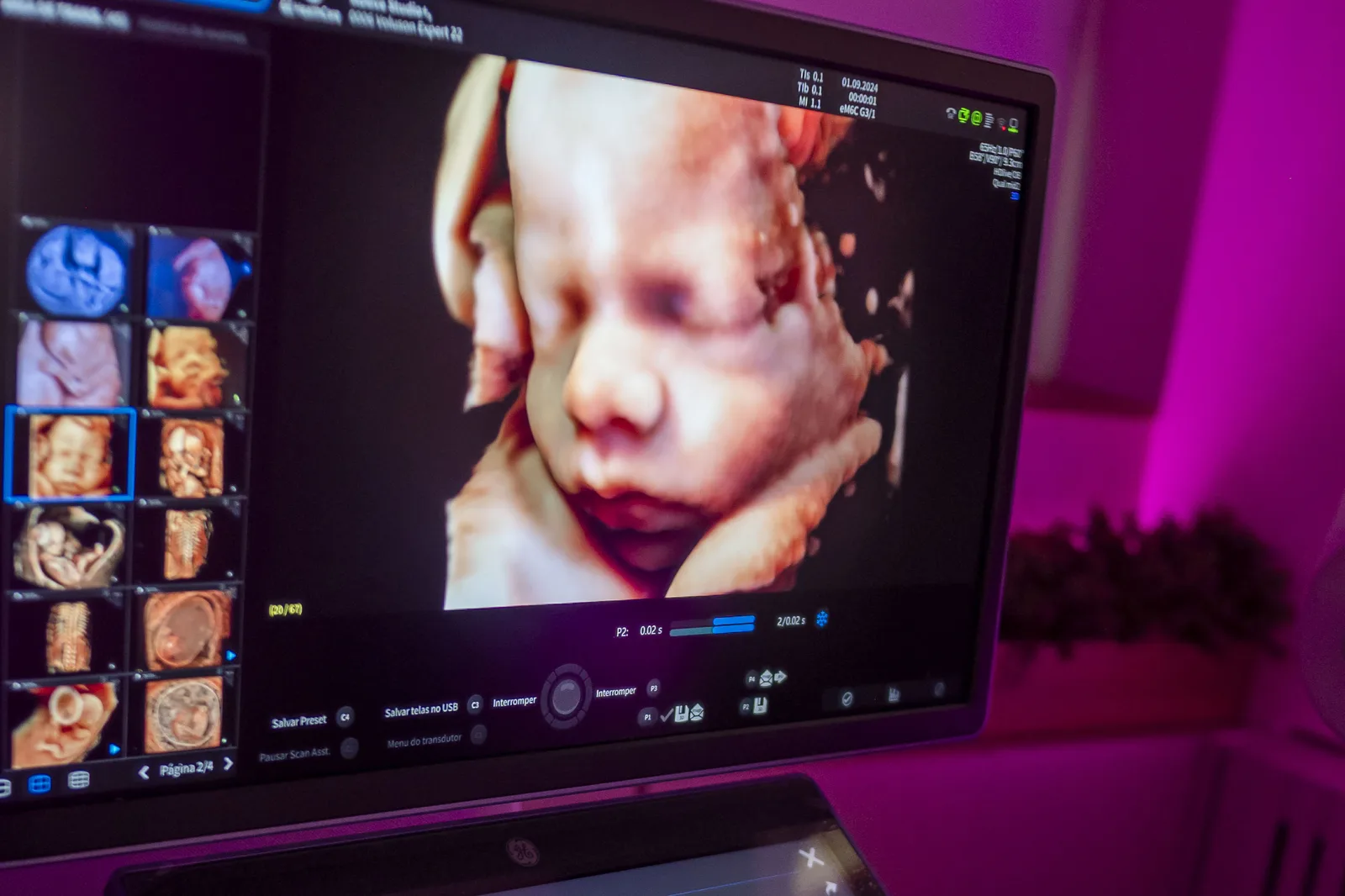 Painel de comandos do aparelho de ultrassom GE Voluson Expert 22, com a imagem do bebê na tela acima