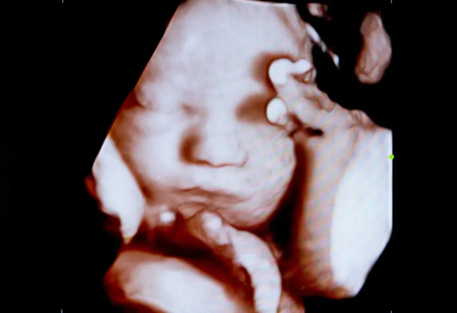 Imagem de ultrassom 3D em volume mostrando o bebê de perfil, com a mão junto ao rosto