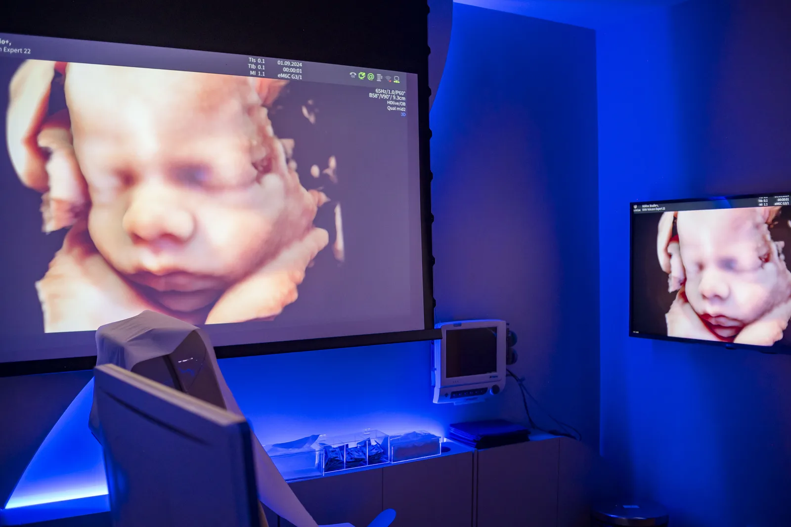 Sala de ultrassonografia com imagem do rosto do bebê em alta definição projetada na tela, com iluminação azul