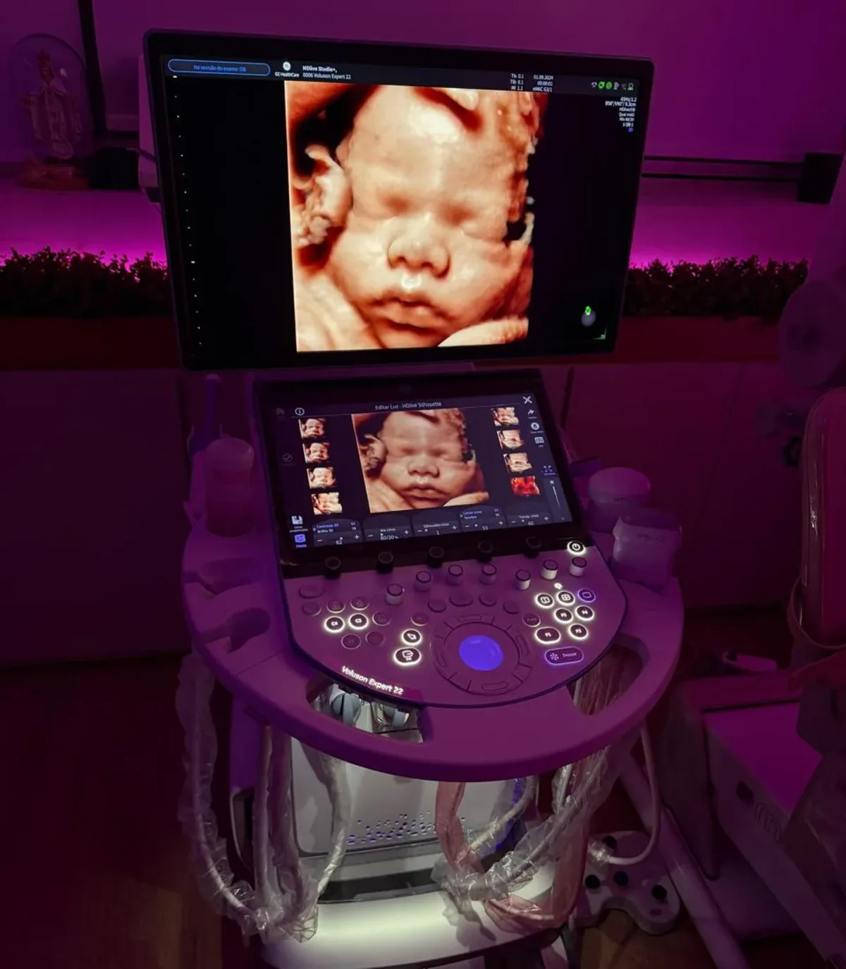 Aparelho GE Voluson Expert 22 com a imagem do bebê na tela e o painel de edição de luz aberto no touch screen